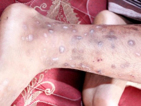 El Dermatológico atendió 14,830 casos de sarna en 10 meses