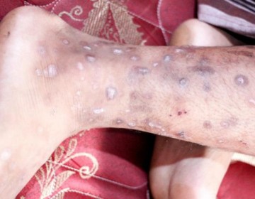 El Dermatol&oacute;gico atendi&oacute; 14,830 casos de sarna en 10 meses