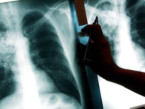 Tuberculosis est&aacute; bajo control pese a da&ntilde;os del Covid