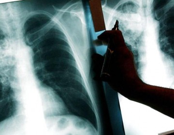 Tuberculosis est&aacute; bajo control pese a da&ntilde;os del Covid