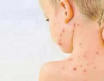 OMS alerta de brotes de sarampi&oacute;n en el mundo tras disminuci&oacute;n de tasa de vacunaci&oacute;n