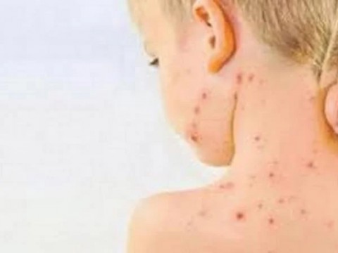 OMS alerta de brotes de sarampi&oacute;n en el mundo tras disminuci&oacute;n de tasa de vacunaci&oacute;n