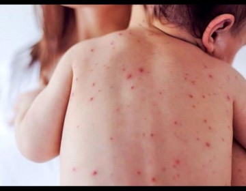 Bolivia confirma un caso de sarampi&oacute;n en una ni&ntilde;a y piden vacunar a los menores