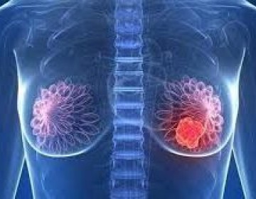 Desinformaci&oacute;n es la principal causa de detecci&oacute;n tard&iacute;a del c&aacute;ncer de mama