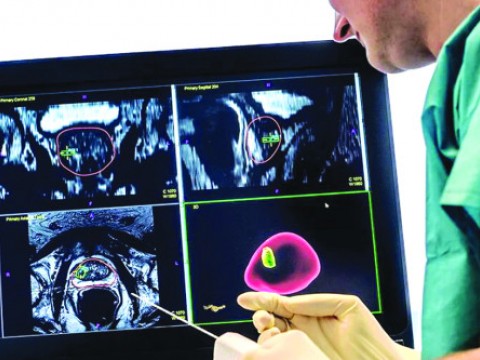 Detectan 5,000 casos c&aacute;ncer de pr&oacute;stata al a&ntilde;o