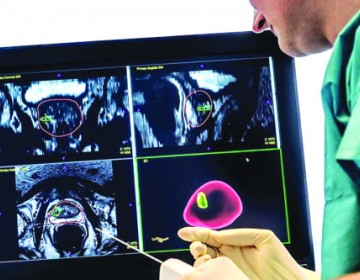 Detectan 5,000 casos c&aacute;ncer de pr&oacute;stata al a&ntilde;o