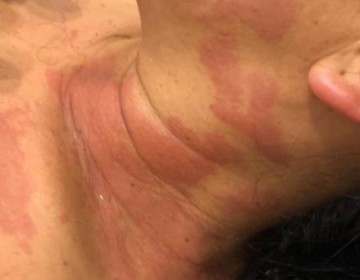 Medusas tienen en zozobra a nadadores y surfistas en playa de Boca Chica