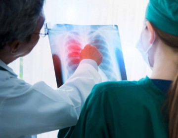 Inmunoterapia, otra alternativa en la lucha contra el c&aacute;ncer de pulm&oacute;n