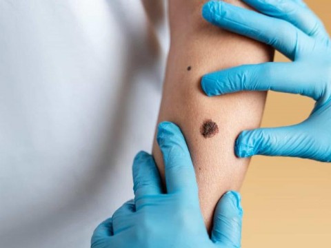 Una vacuna reduce a la mitad el riesgo de reca&iacute;da en c&aacute;ncer de piel