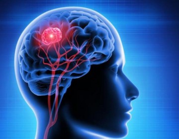 Una nueva herramienta basada en IA permitir&aacute; mejorar el diagn&oacute;stico de tumores cerebrales