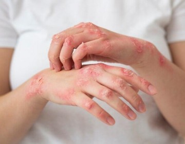 Dermatol&oacute;gico asiste actualmente a 205 pacientes por lepra