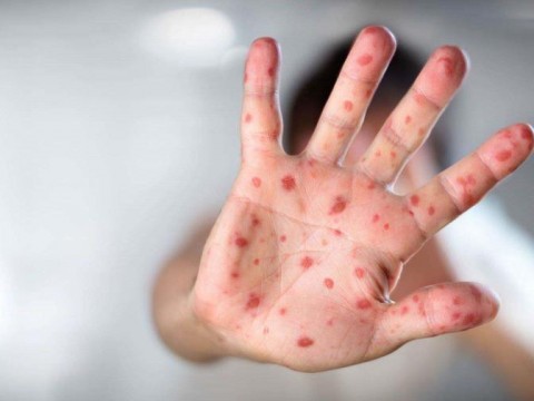 OMS: m&aacute;s de la mitad de los pa&iacute;ses sufrir&aacute;n alto riesgo de brotes de sarampi&oacute;n este a&ntilde;o