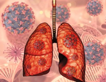 En el pa&iacute;s se detectan 4,000 casos de tuberculosis cada a&ntilde;o